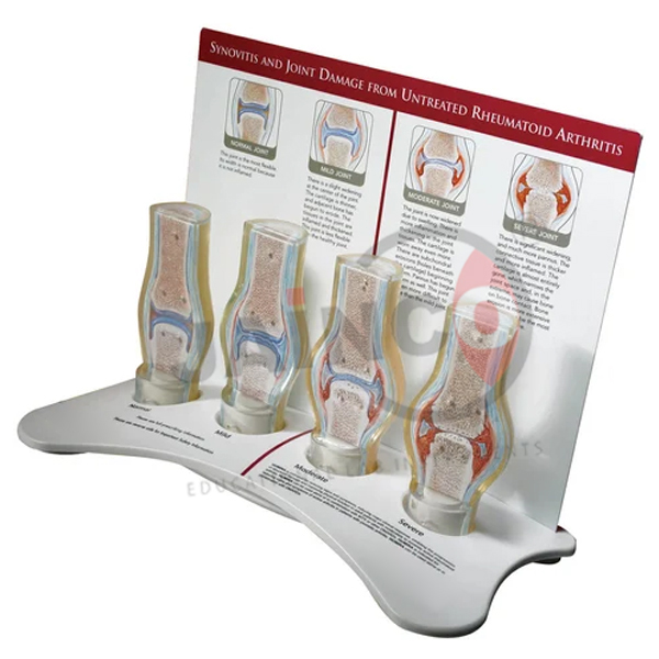 Rheumatoid Arthritis Generic Joint Model
