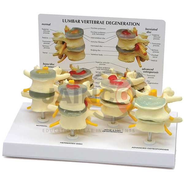 Vertebrae Degeneration Models