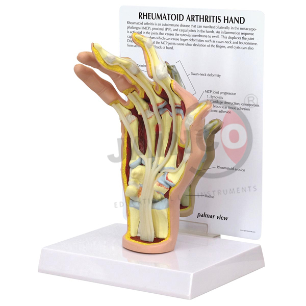 Hand Arthritis Model