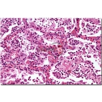 Lobar Pneumonia Grey Hepatisation Model