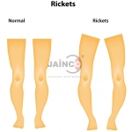 Rickets Model