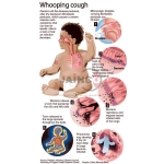 Bordetella Pertussis and Disease Model