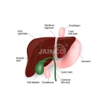 Cholalithiasis Gall Stone Model