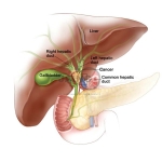 Cancer Detoxification Model