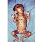 Tetanus of Baby Model