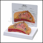 Breast Cancer Model