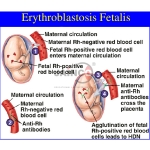 Erythroblastosis Fetalis Model