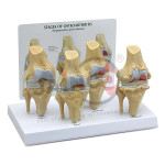 Knee Arthritis Model