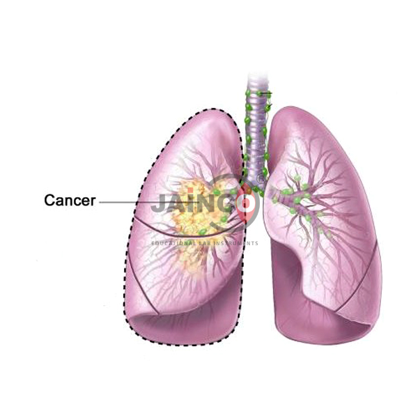 Lung Cancer Model