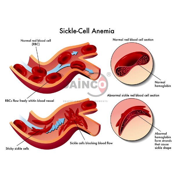 Sickle Cell Anemia Model
