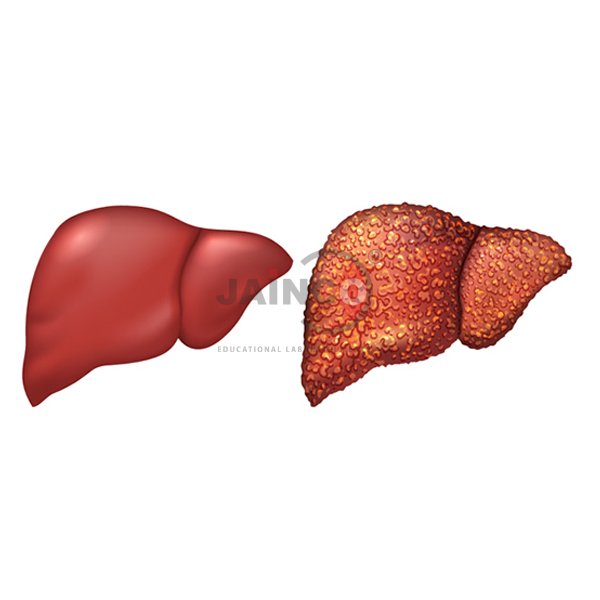 Cirrhosis Liver Model