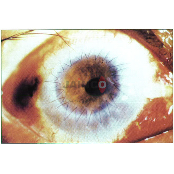 Trachoma Model