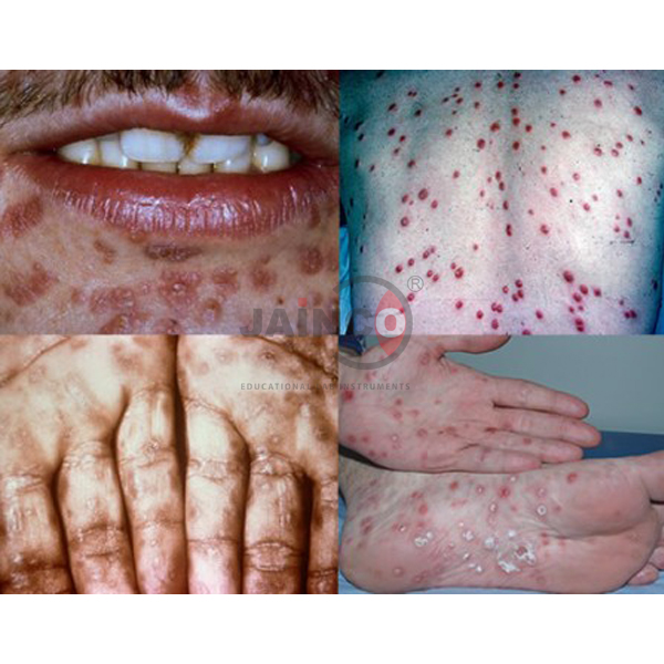 Clinical Stages of Untreated Syphilis Model