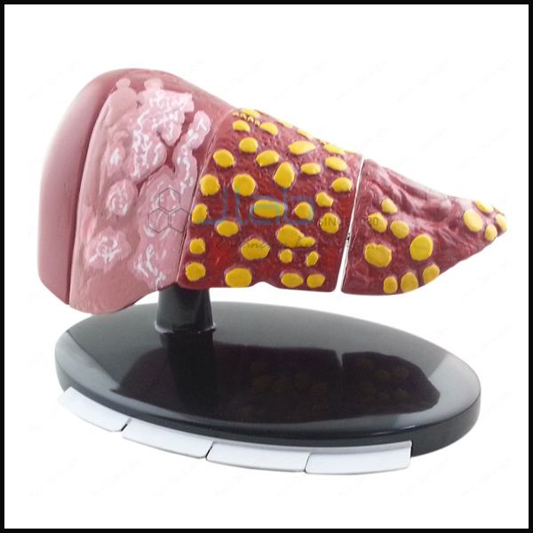 Four Stage Liver Model