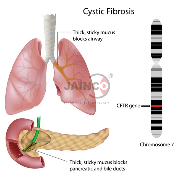 Cystic Fibrosis Model