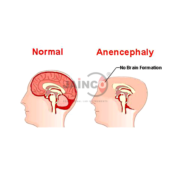 Anencephaly Model