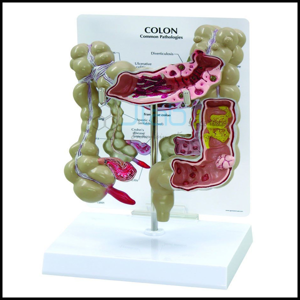 Colon Model With Pathologies