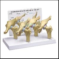 Hip Osteoarthritis Model