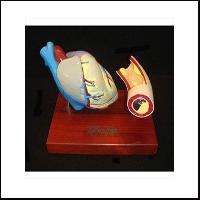 Heart With Artery Blockage Model