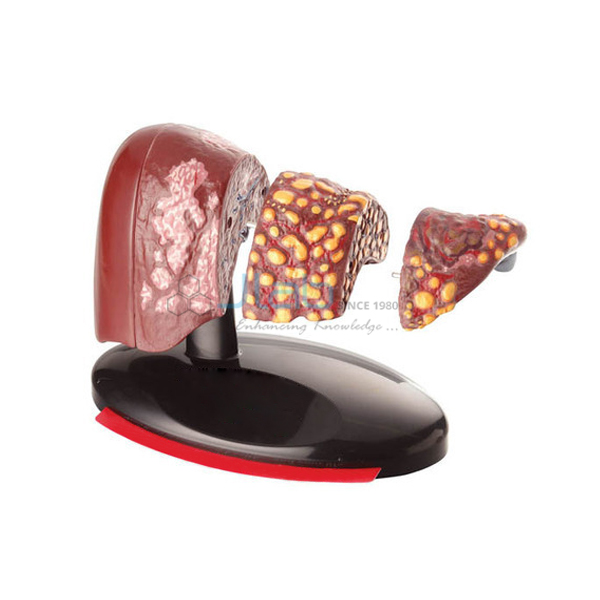 Four Stage Liver Models