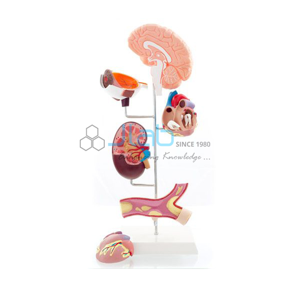 Hypertension Model 6 Parts
