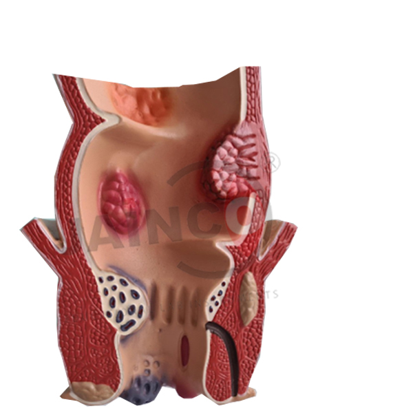 Piles Model
