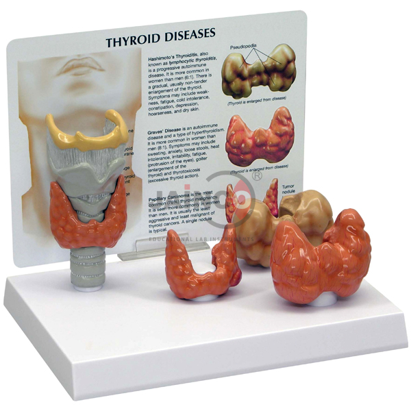 Common Goiter Model