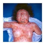 Maggot on Top Underneath Skin Model