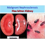 Malignant Nephrosclerosis, Flea Bitten Kidney Model