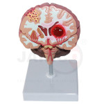 Brain Stroke Model