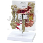 Colon Model With Pathologies