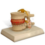 Disc Prolapse Simulator Model