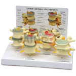Vertebrae Degeneration Models