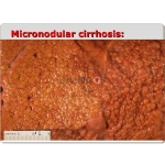 Micronodular Cirrhosis Model