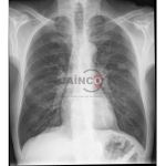 T.B. Infiltration in Lungs Model