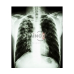 T.B. with Lung Cavity Model