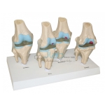 4 Stages of Knee Joint Diseases