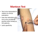 Mantoux Test Model