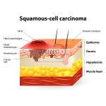 Squamous Cell Carcinoma Model