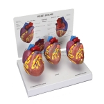 Human Heart Disease Model